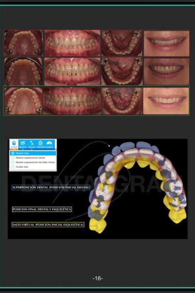 FOTOS-CASOSCLINICOS.avanzado-esp-invisa-2020 invisalign.002