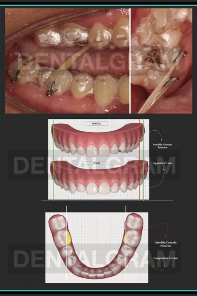 FOTOS-CASOSCLINICOS.avanzado-esp-invisa-2020 invisalign.003