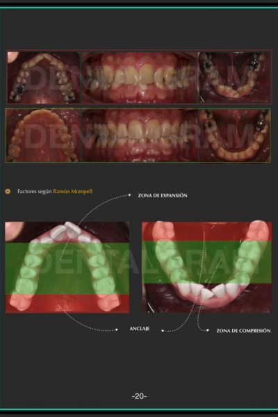 FOTOS-CASOSCLINICOS.avanzado-esp-invisa-2020 invisalign.006