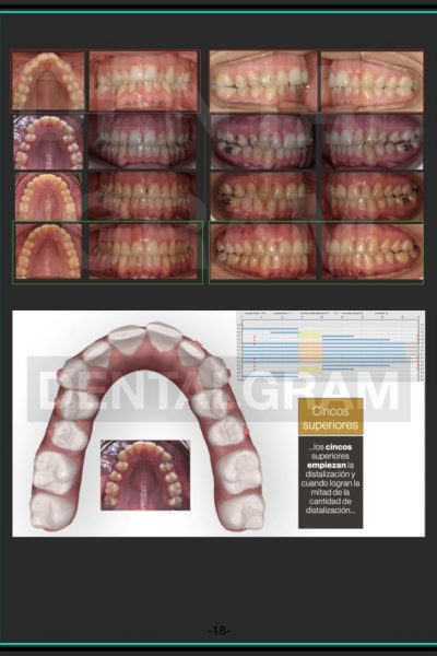 FOTOS-CASOSCLINICOS.avanzado-esp-invisa-2020 invisalign.010