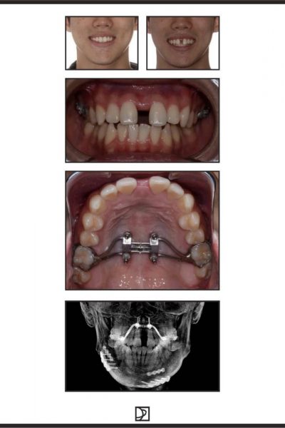 casos-clinicos-curso-Minimplantes-20192035