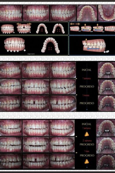 casos-clinicos-curso-Minimplantes-2019206