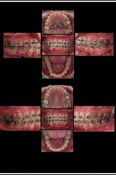 casos-clinicos-curso-Minimplantes-20192066