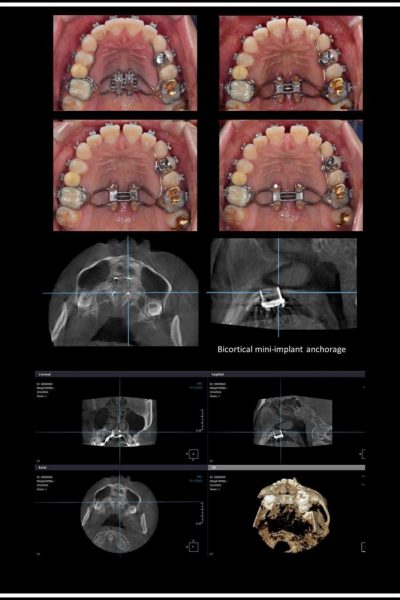 casos-clinicos-curso-Minimplantes-2019240