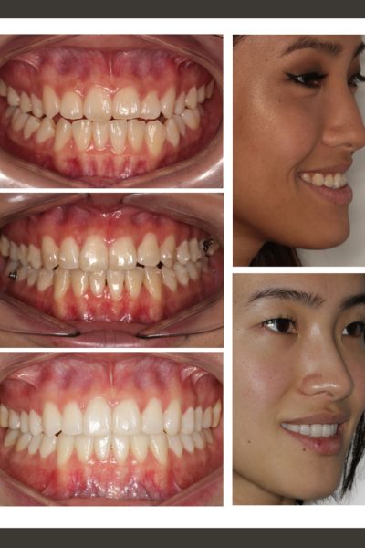 ‎casos ramon.‎003